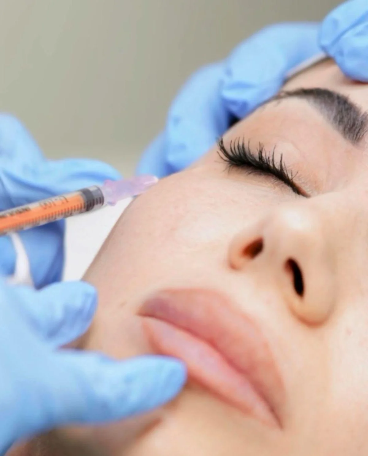 Botox classico per le rughe del viso