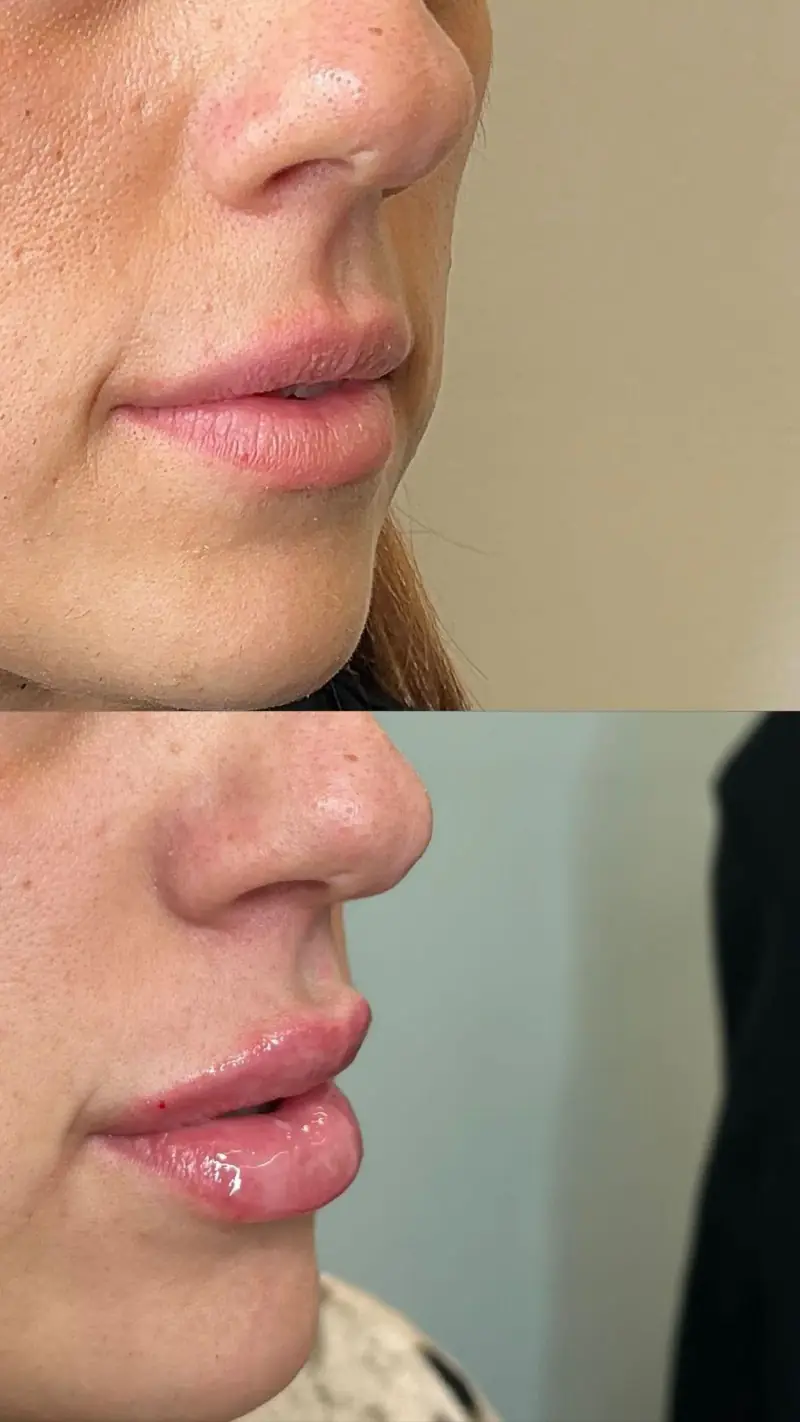 Filler labbra Bit Volume