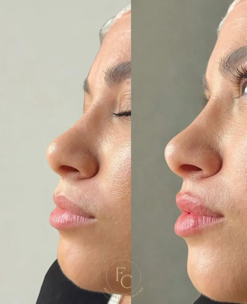 Filler labbra Hydra idratante