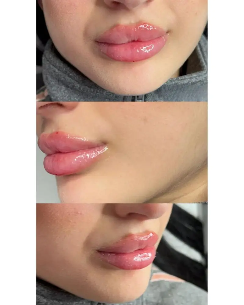 Filler labbra Russian Lips