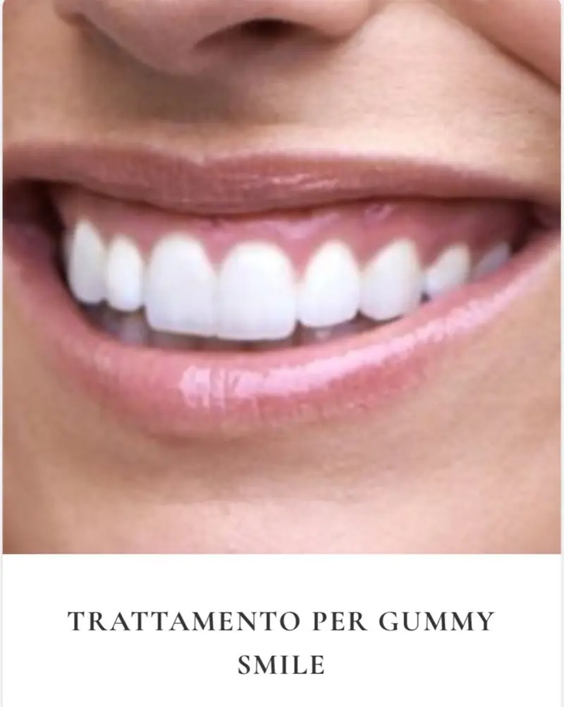 Trattamento gummy smile