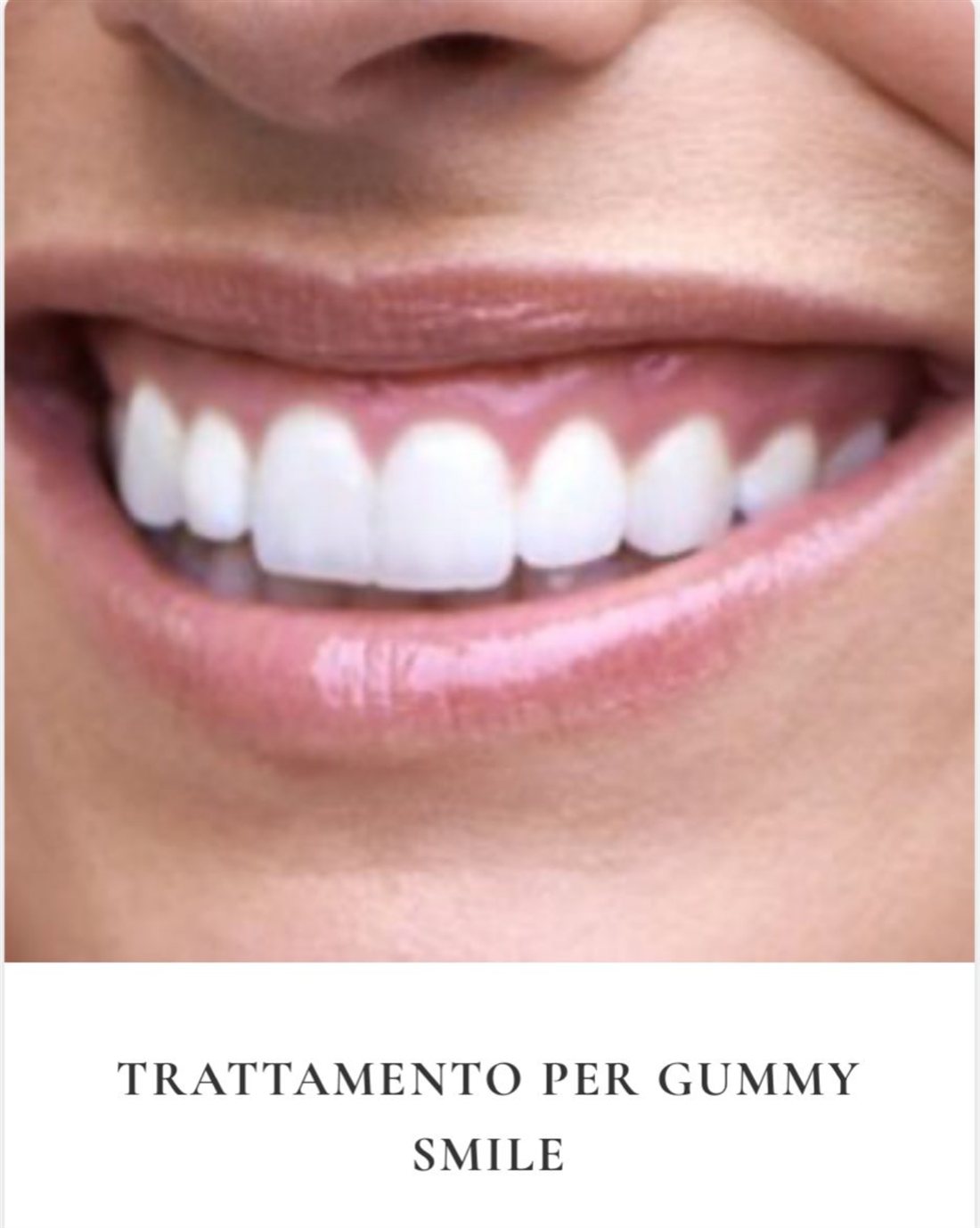 Trattamento gummy smile